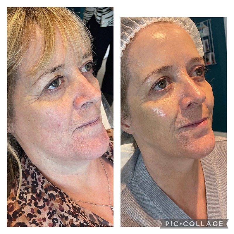 Sunekos Performa (aka Sunkeos 200) - Image 4