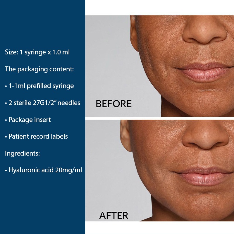 Restylane Defyne Lidocaine Dermal Filler - Image 4