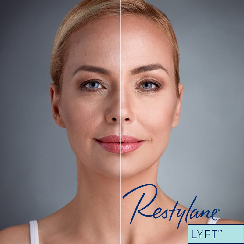 Restylane Lyft with Lidocaine Dermal Filler - Image 4