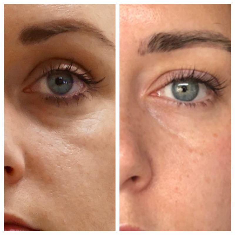 Sunekos 1200 Mesotherapy Revitalisation - Image 5