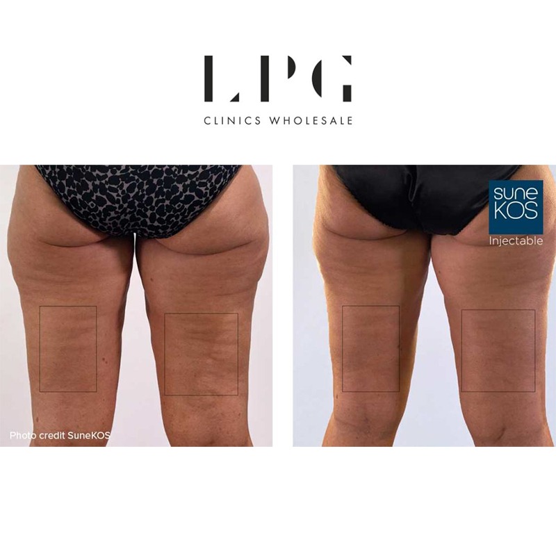 Sunekos Body Mesotherapy Gel - Image 4