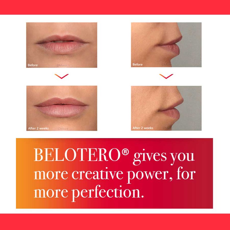 Lip Filler Belotero Lips Shape with Lido - Image 4